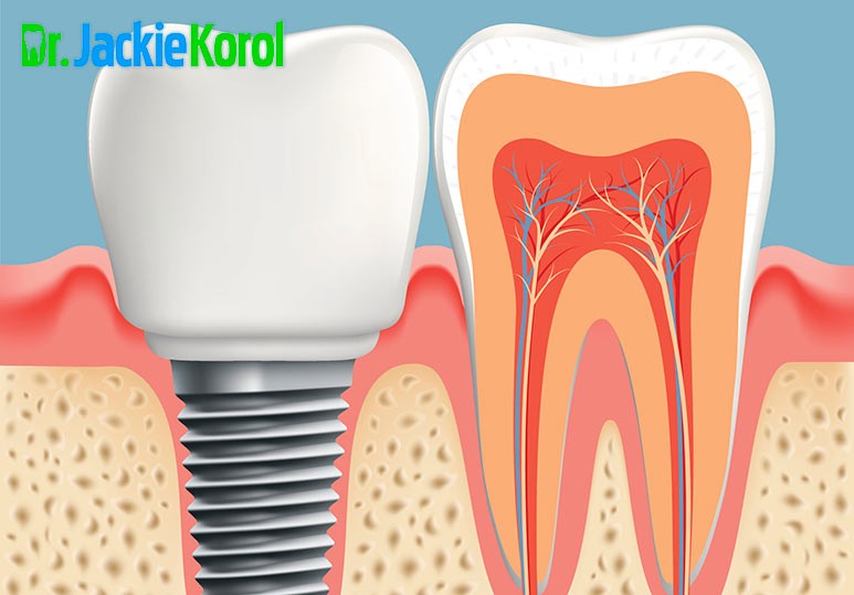 Dr. Jackie Korol What is a Tooth Implant?