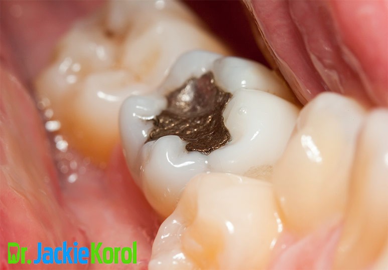 Dr. Jackie Korol Mercury Fillings: Effects and Safe Removal Practices