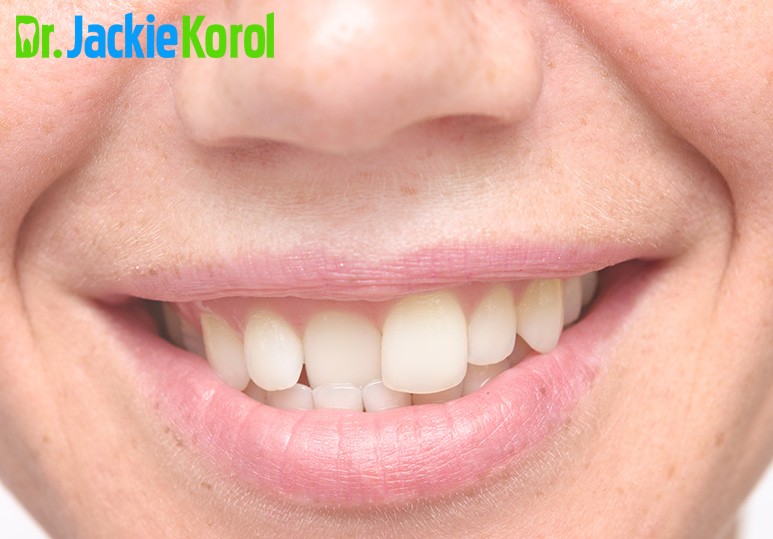Dr Jackie Korol Dentist Calgary Alberta Could Crooked or Misaligned Teeth Be Bad for your Health?