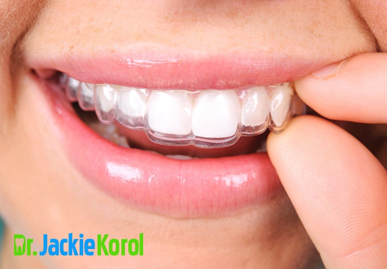 5 Key Things You Need to Know About Invisalign Before Committing 