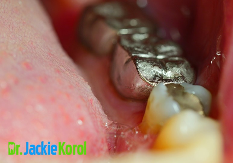 safe mercury removal, safe mercury removal Calgary, Calgary safe mercury removal, mercury free dentistry Calgary, dental amalgam Calgary, amalgam removal dentist Calgary, emergency dental Calgary
