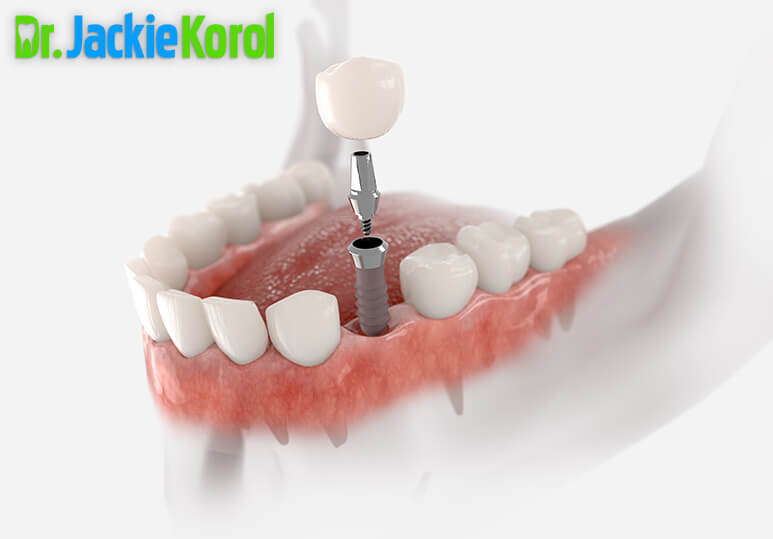 Dr Jackie Korol - Blog -  How Well Does Your Crown Fit_