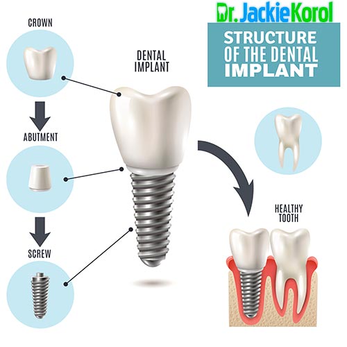 Dental Implant Structure Diagram