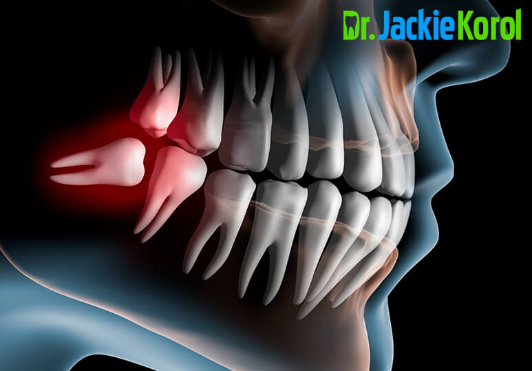 True Or False: Exploring The Common Myths About Wisdom Teeth